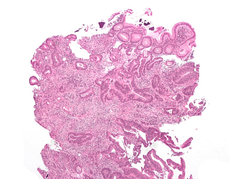 File:Cecal adenocarcinoma.jpg