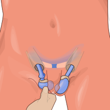 Testicular torsion.svg