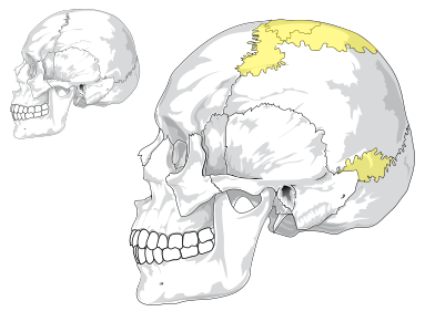 File:Wormian bones.svg