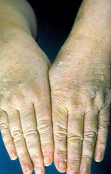 File:Cowden-disease2.jpg