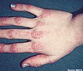 Gottron's papules. Discrete erythematous papules overlying the metacarpal and interphalangeal joints in a patient with juvenile dermatomyositis.