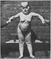 Pfeiffer syndrome