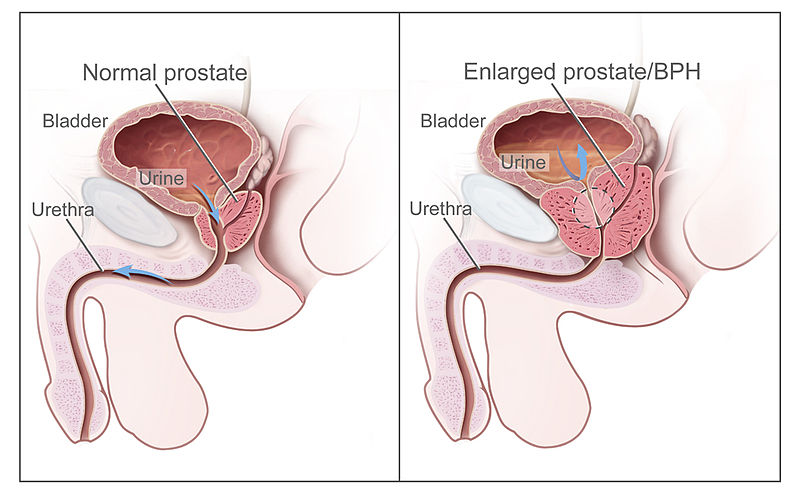 Файл:Benign Prostatic Hyperplasia nci-vol-7137-300.jpg