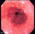 Thumbnail for Esophageal candidiasis