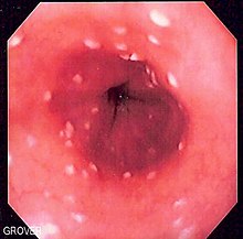 Esophageal candidiasis.jpg