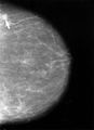 Mammogram displaying breast cancer, indicated with an arrow