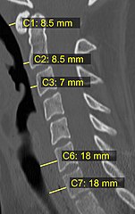 CT scan with upper limits of the thickness of the prevertebral space at different levels.[7]