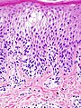 Histopathological image of dyshidrotic dermatitis, showing focal spngiotic change in the epidermis.