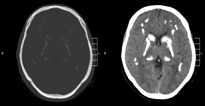 File:Fahr syndrome.gif