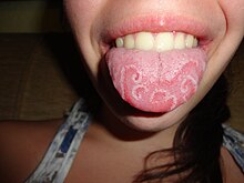 Geographic tongue.JPG