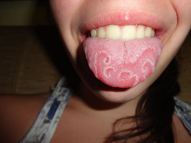 File:Geographic tongue.JPG