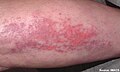 Linear extensor erythema involving the forearm. This image demonstrates linear violaceous discrete and confluent macules, and erosions secondary to excoriation. Pruritus is an under-recognized symptom of active dermatomyositis.