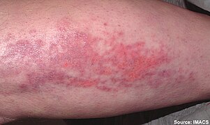 Forearm rash