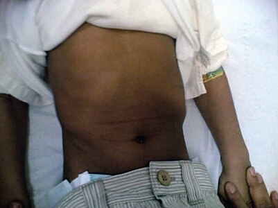 Photo of the chest cage with pectus excavatum and scorbutic rosaries.