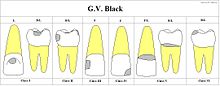 Chart showing digitally drawn images of caries locations and their associated classifications.