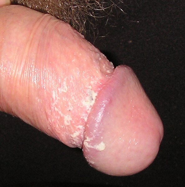 File:Smegma Penis02.mirrored.jpg