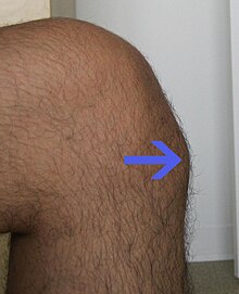 25-year-old male with Osgood–Schlatter disease.