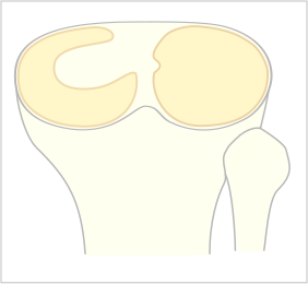 File:Scheibenmeniscus.svg