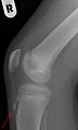 X-ray showing Osgood-Schlatter disease (arrow).