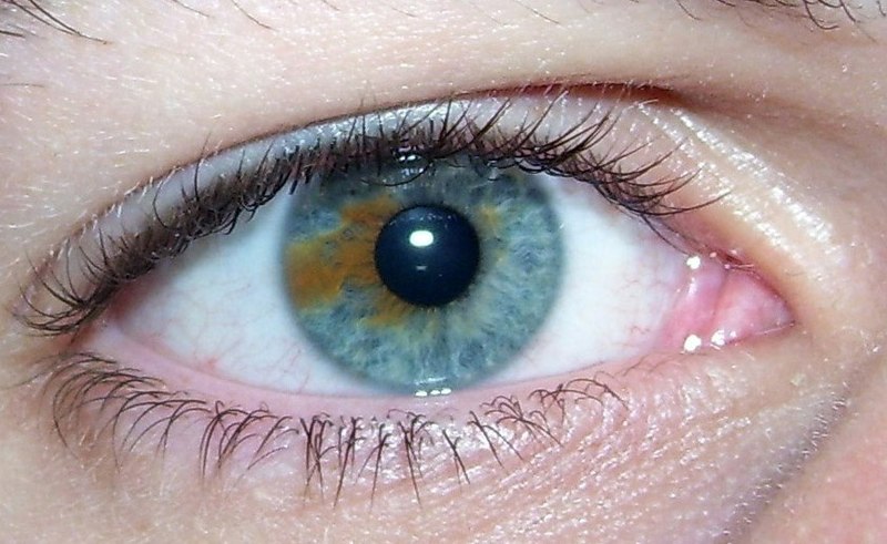 File:Sectoral heterochromia.jpg