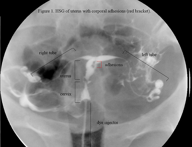 File:HSG Ashermans syndrome.jpg