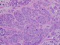 High-grade invasive ductal carcinoma, with minimal tubule formation, marked pleomorphism, and prominent mitoses, 40x field.