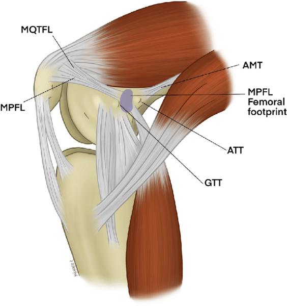 File:Medial-view-of-a-flexed-knee-is-shown-Anatomy-of-the-MPFL-AMT-adductor-magnus-tendon.png