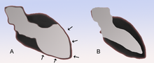 Thumbnail for Takotsubo cardiomyopathy