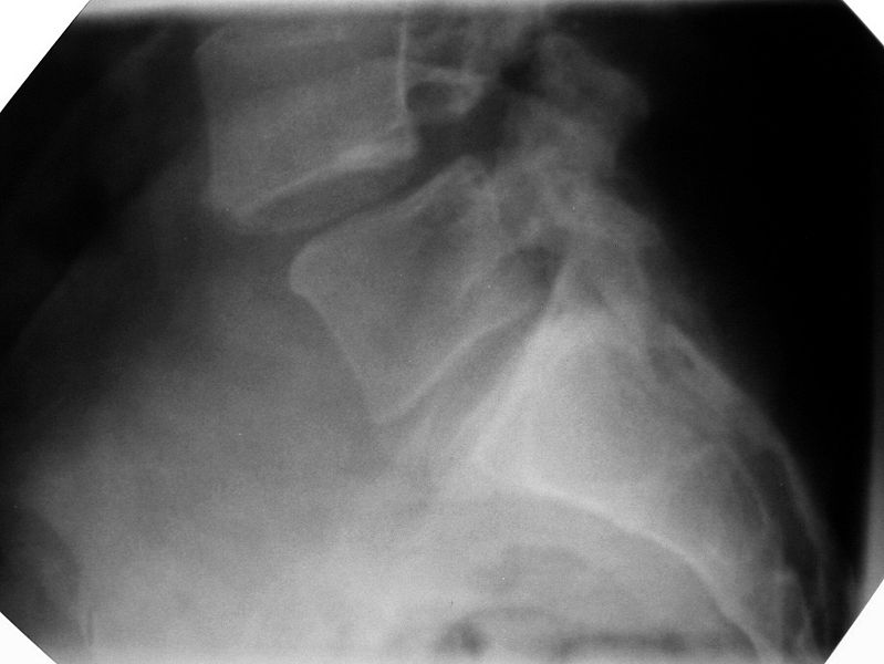 File:Spondylolisthesis.jpg