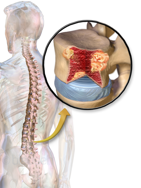 File:Blausen 0656 MultipleMyeloma.png