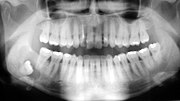 Dentigerous cyst tooth 48