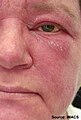 Malar and facial erythema. Striking malar and facial erythema with facial edema and scale represents a recent disease flare in an adult patient with dermatomyositis.