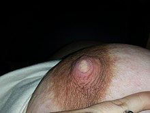 A photo showing a nipple and areola. A small region at the middle of the nipple pore is lighter in colour, indicating a reduced blood flow(vasospasm). Nipple blanching is a symptom of poor positioning and latching in breastfeeding.