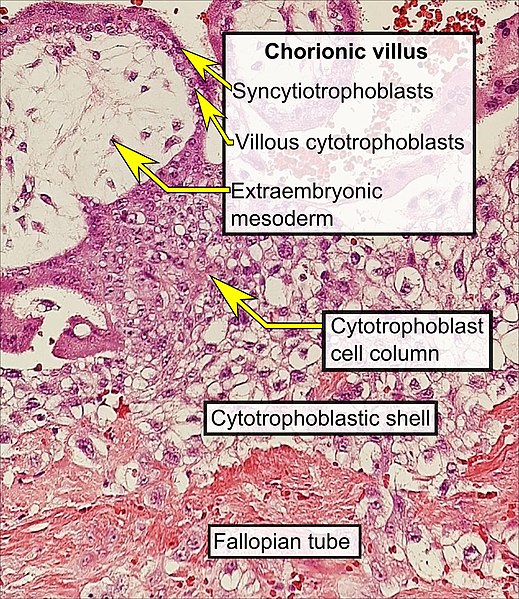 File:Histopathology of tubal pregnancy.jpg