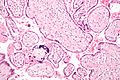 Micrograph of a placental infection (CMV placentitis).