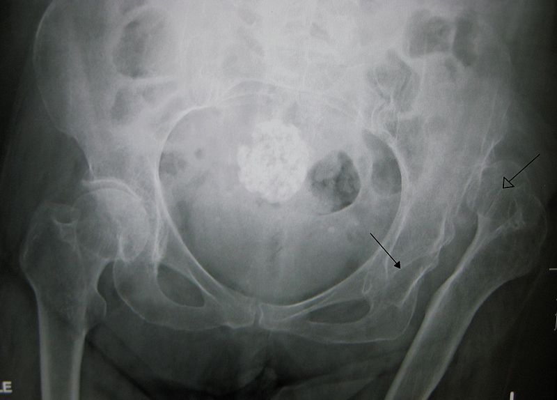 File:Congenitaldislocation10.JPG