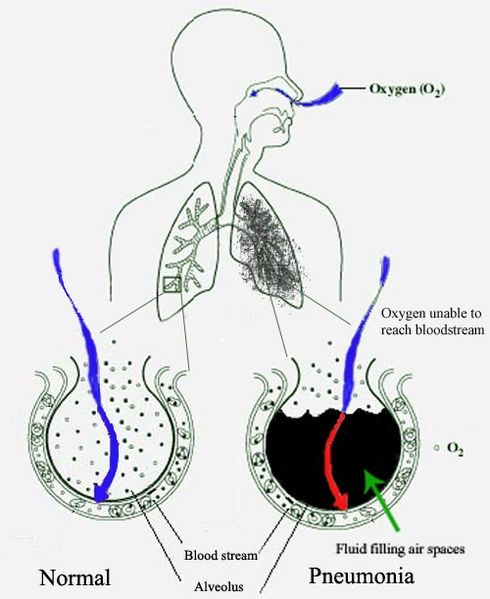 File:New Pneumonia cartoon.jpg