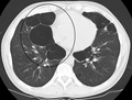 Axial CT image of the lung of a person with end-stage bullus emphysema.