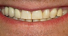 Closeup of a smiling mouth with teeth showing minor white streaks on one tooth.