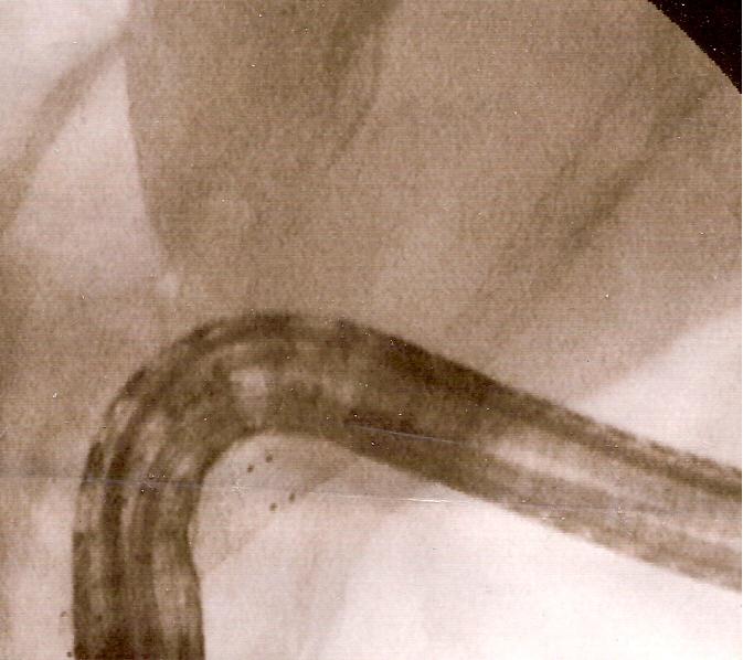 File:Fluoro biliary SEMS.jpg