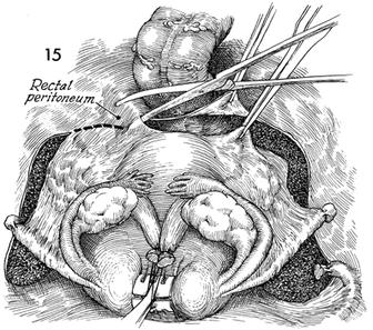 File:Radical hysterectomy.jpg