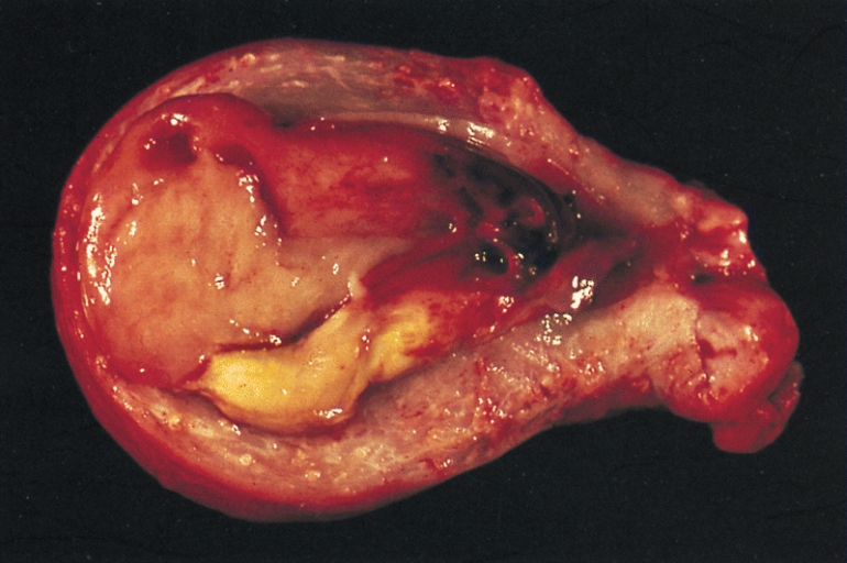 File:Endometrial stromal sarcoma gross.jpg