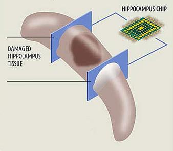 File:Hippocampal Prosthesis.jpg