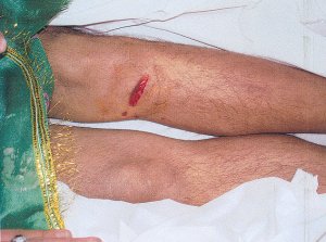 File:Abdul Basir's torture scars.jpg