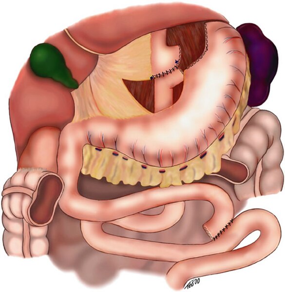 File:Gastric Byypass, Roux en-Y.jpg