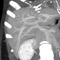 MDCT image. Portal venous anatomy contraindicated for liver donation.